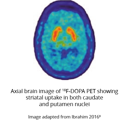 Figure showing the striatal uptake of dopamine in the caudate and putamen nuclei